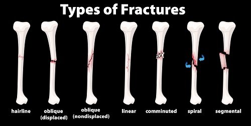 Illustration showing different types of bone fractures: hairline, oblique (displaced), oblique (nondisplaced), linear, comminuted, spiral, and segmental.