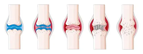 Illustration showing the stages of joint degeneration, from healthy cartilage to advanced joint damage due to arthritis.