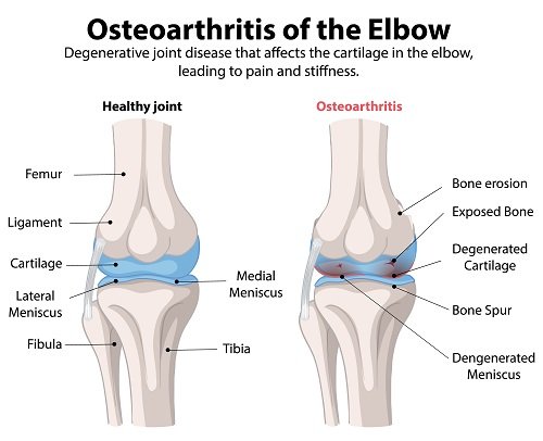 Illustration comparing a healthy elbow joint with one affected by osteoarthritis, showing cartilage degradation, bone erosion, and the formation of bone spurs.