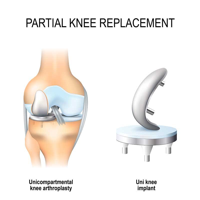 Illustration showing partial knee replacement surgery with a unicompartmental knee arthroplasty and uni knee implant.