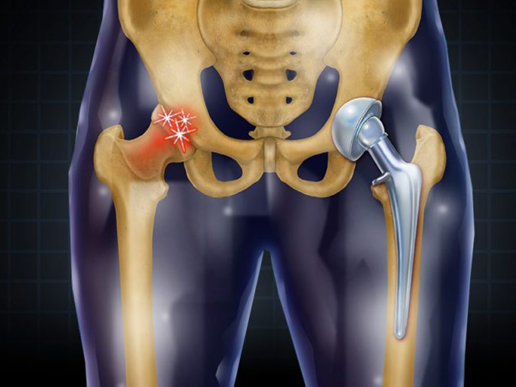 Illustration of a hip joint showing arthritis on one side and a hip replacement implant on the other side.