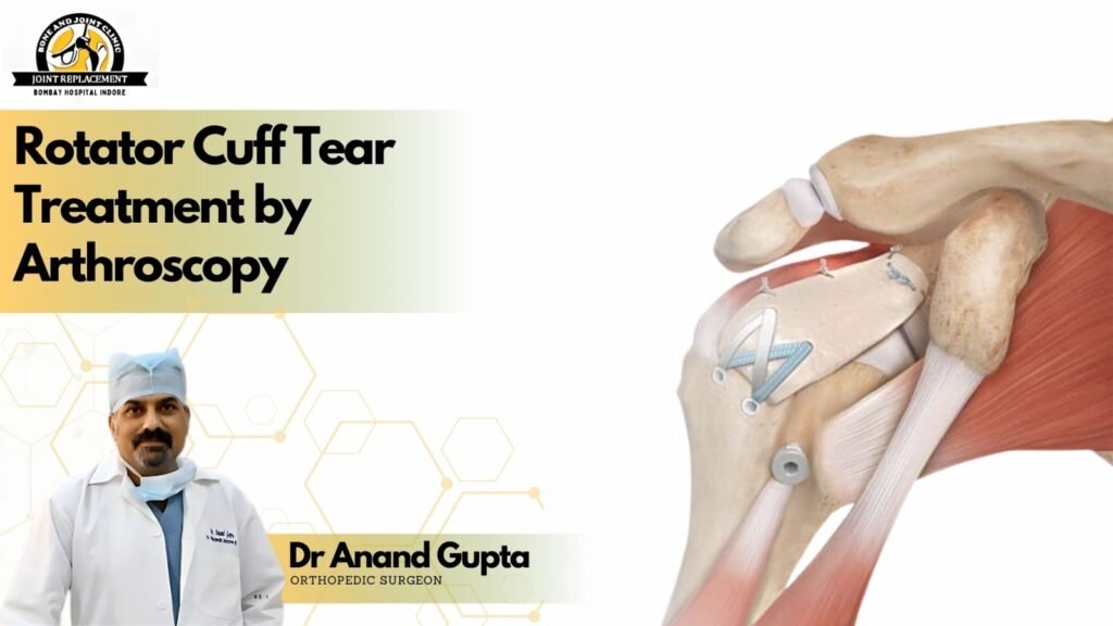 Illustration of shoulder rotator cuff repair treatment with arthroscopy, featuring Dr. Anand Gupta, an orthopedic surgeon from Indore.