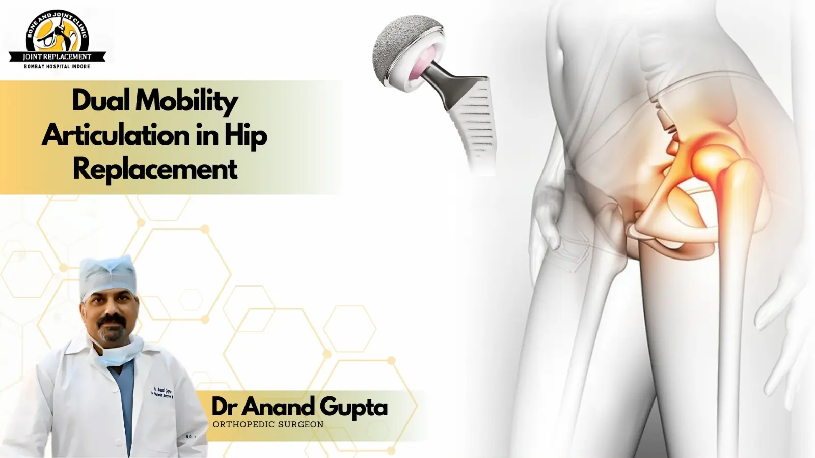 Dual mobility articulation in hip replacement implant with hip joint illustration and Dr Anand Gupta Orthopedic Surgeon in Indore
