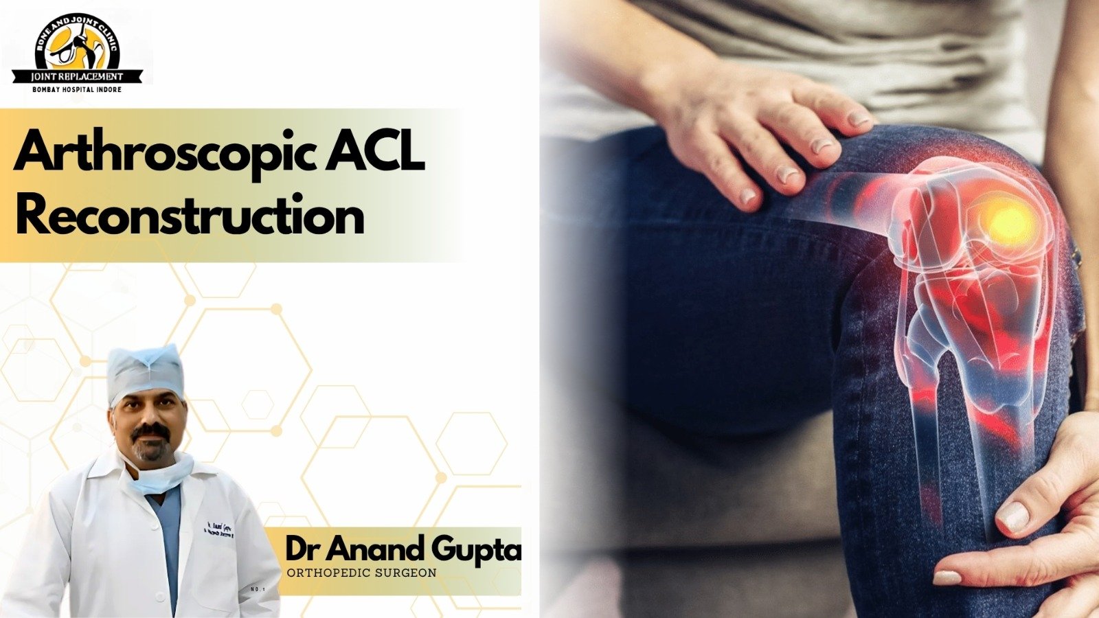 Arthroscopic ACL reconstruction in Indore by Dr Anand Gupta orthopedic surgeon showing knee ligament injury treatment