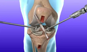 ACL reconstruction surgery in Indore using arthroscopy technique by Dr. Anand Gupta for knee ligament injury treatment